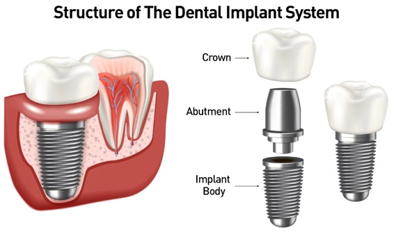 dental-implants-park-slope